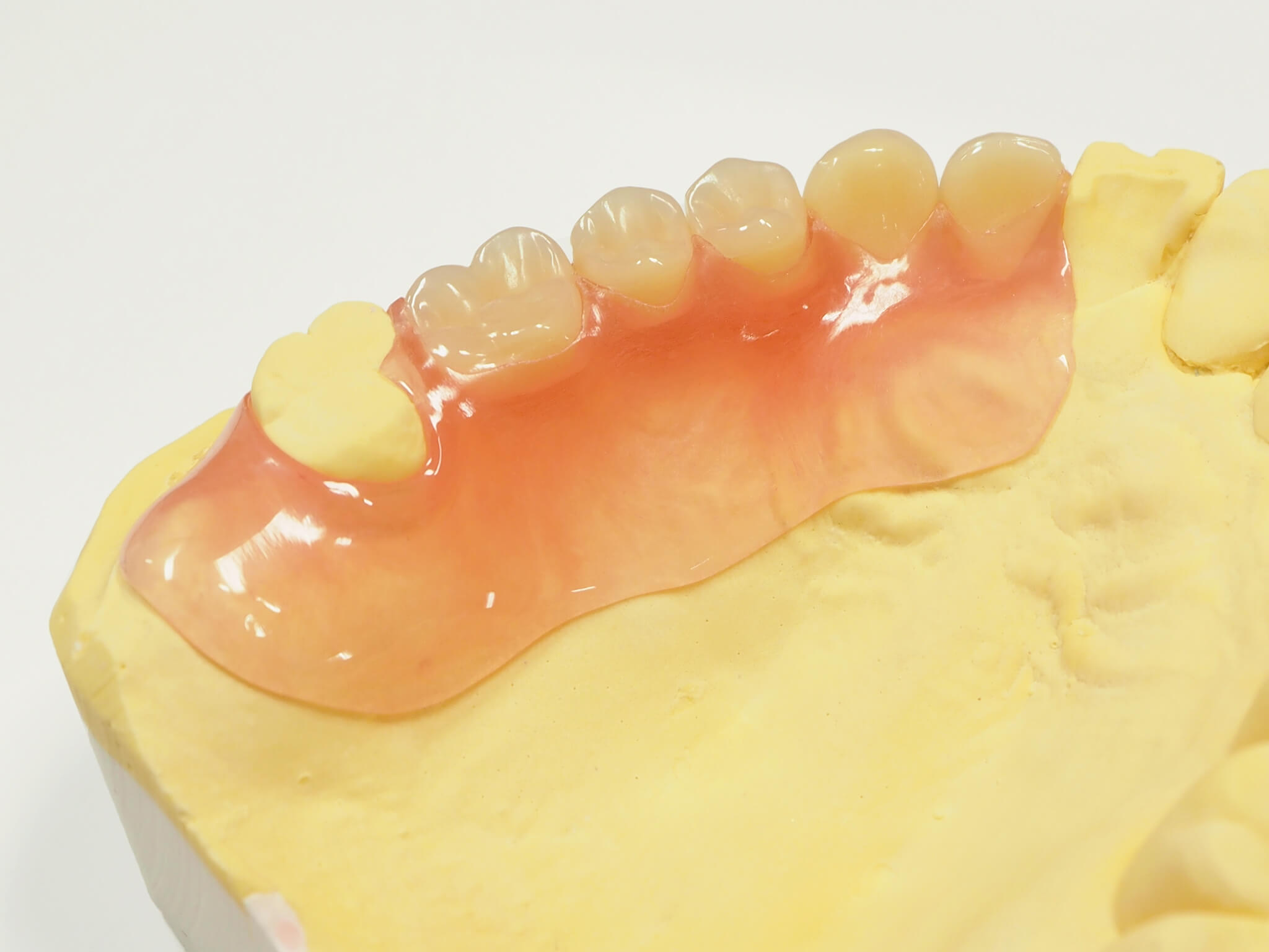 垂水区でオーダーメイドで作製する自費の入れ歯(義歯)を提供しています。