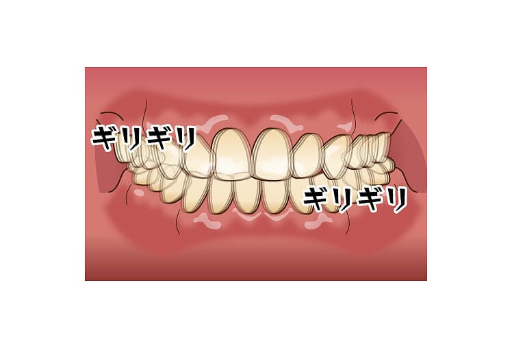 歯ぎしり、食いしばりでお悩みの方へ