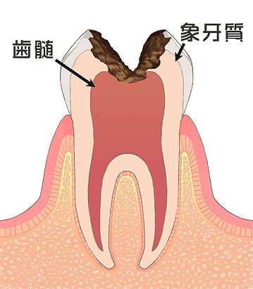 虫歯が進行し、感染が歯髄にまで達した場合