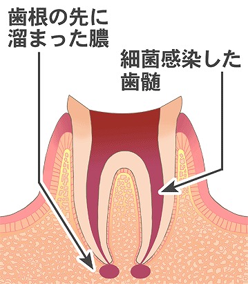 根管治療後に根管内で再感染を起こした場合