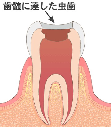 虫歯に侵された歯や歯髄を削る