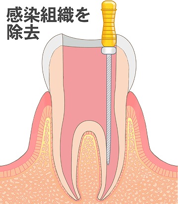 神経を取り除き、根をきれいに清掃