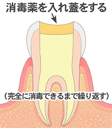 薬剤を詰める