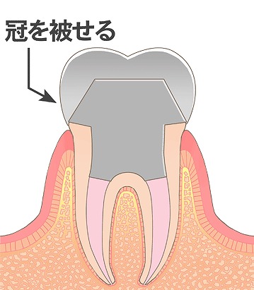 コアを入れ、クラウン(被せ物)を調整