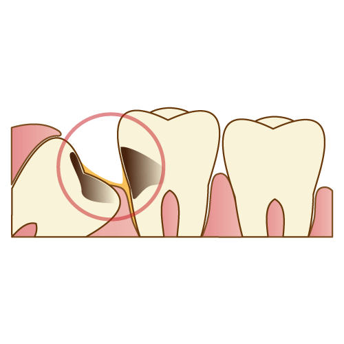 親知らずや親知らずの手前の歯が虫歯になる|神戸市垂水区で親知らずを行う梶歯科医院