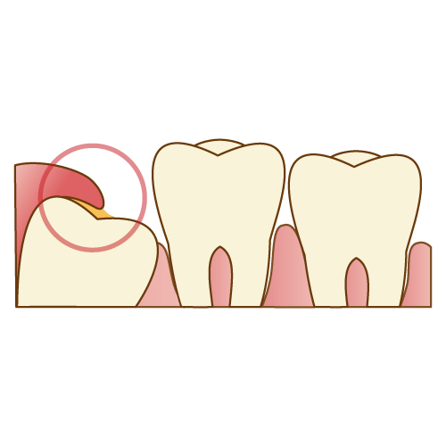 歯周炎のリスクが高まる|神戸市垂水区で親知らずを行う梶歯科医院