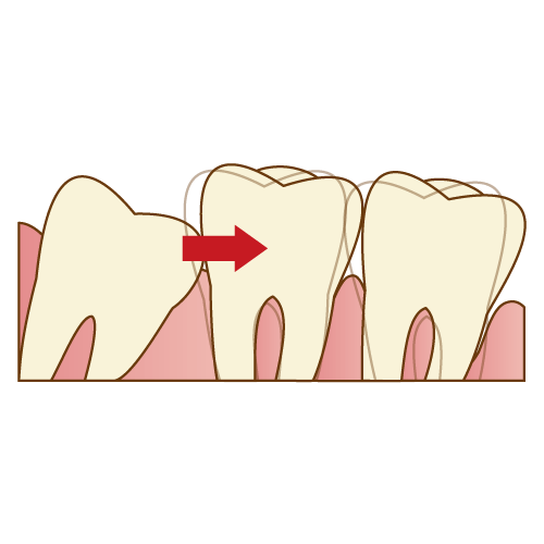 歯並びを乱すことがある|神戸市垂水区で親知らずを行う梶歯科医院