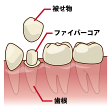ファイバーコア（セラミック治療）